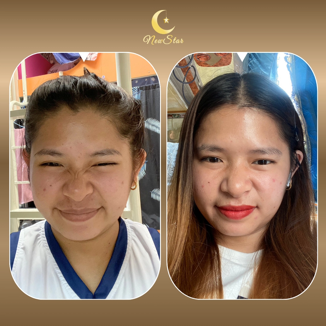 BOTOX HÀN QUỐC NABOTA