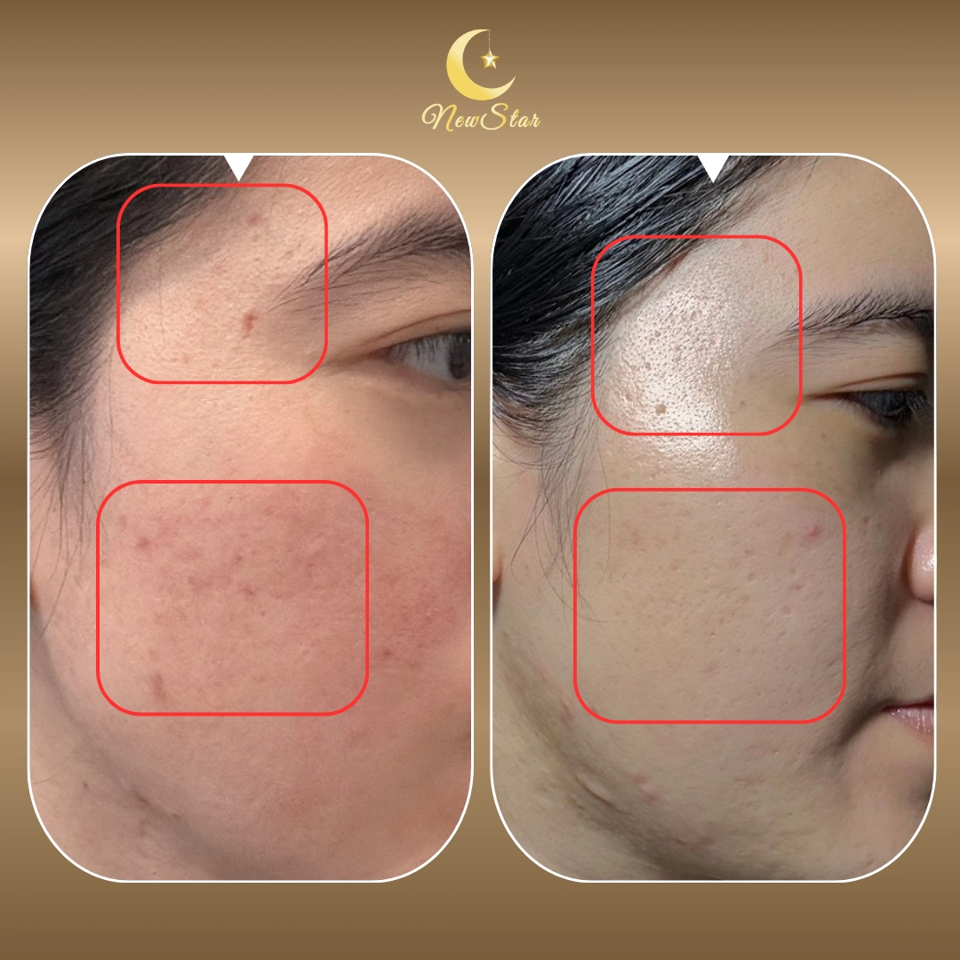 PICOBEE TRỊ SẸO RỖ