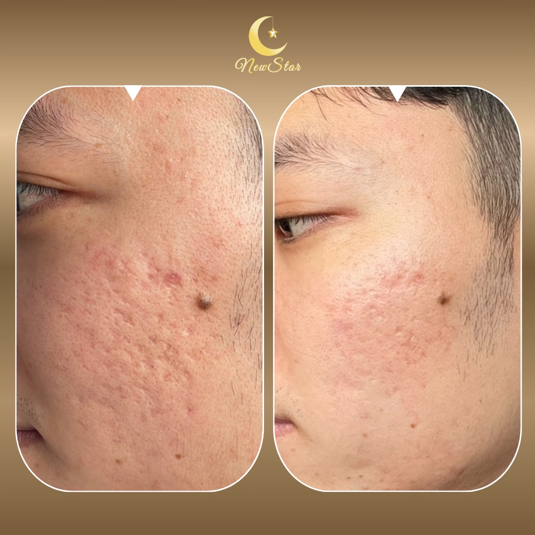 PICOBEE TRỊ SẸO RỖ